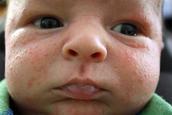 Pictures Of Babies Face Rash 70